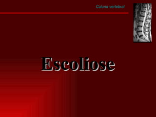 Coluna vertebral Escoliose 
