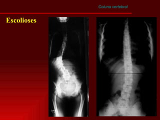 Coluna vertebral Escolioses 