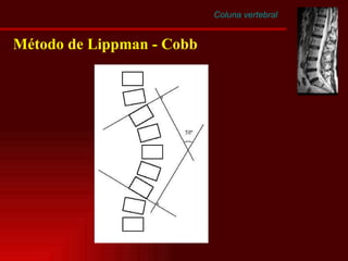 Coluna vertebral Método de Lippman - Cobb 