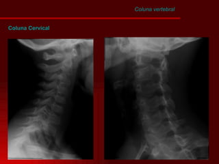 Coluna Cervical Coluna vertebral 