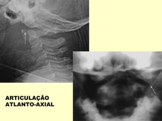 ARTICULAÇÃO
ATLANTO-AXIAL
 