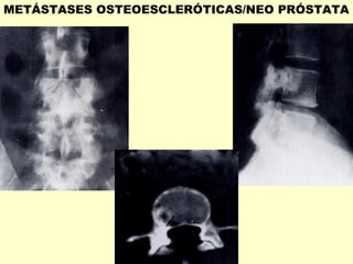 METÁSTASES OSTEOESCLERÓTICAS/NEO PRÓSTATA
 