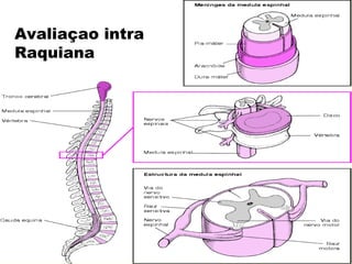 Avaliaçao intra
Raquiana
 