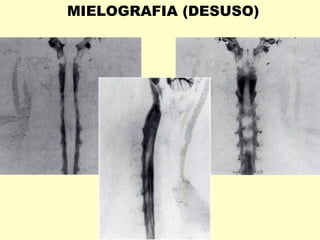 MIELOGRAFIA (DESUSO)
 