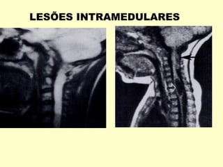LESÕES INTRAMEDULARES
 