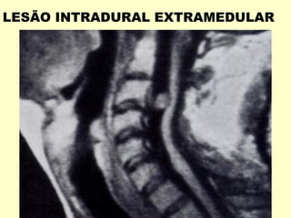 LESÃO INTRADURAL EXTRAMEDULAR
 