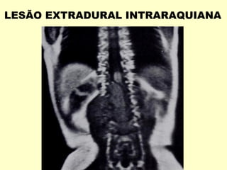 LESÃO EXTRADURAL INTRARAQUIANA
 