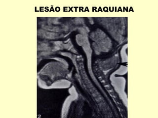 LESÃO EXTRA RAQUIANA
 