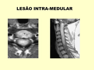 LESÃO INTRA-MEDULAR
 
