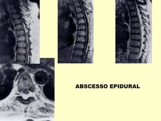 ABSCESSO EPIDURAL
 