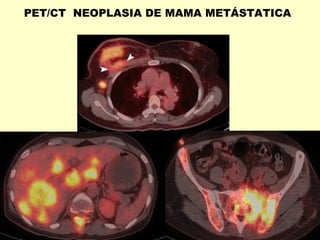 PET/CT NEOPLASIA DE MAMA METÁSTATICA
 