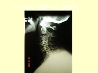 COLUNA CERVICAL PERFIL
 