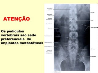 ATENÇÃO

Os pedículos
vertebrais são sede
preferenciais de
implantes metastáticos
 