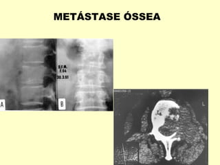 METÁSTASE ÓSSEA
 