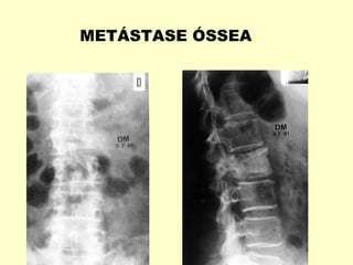 METÁSTASE ÓSSEA
 
