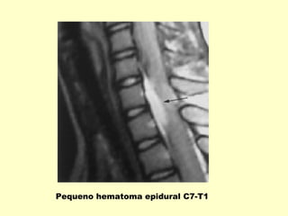 Pequeno hematoma epidural C7-T1
 