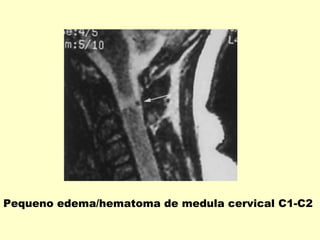 Pequeno edema/hematoma de medula cervical C1-C2
 