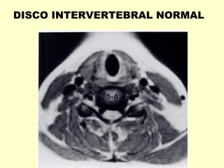 DISCO INTERVERTEBRAL NORMAL
 