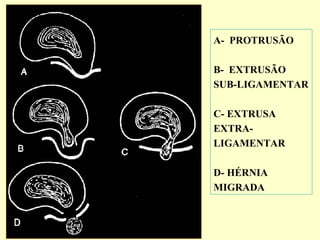 A- PROTRUSÃO

B- EXTRUSÃO
SUB-LIGAMENTAR

C- EXTRUSA
EXTRA-
LIGAMENTAR

D- HÉRNIA
MIGRADA
 