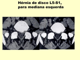 Hérnia de disco L5-S1,
para mediana esquerda
 