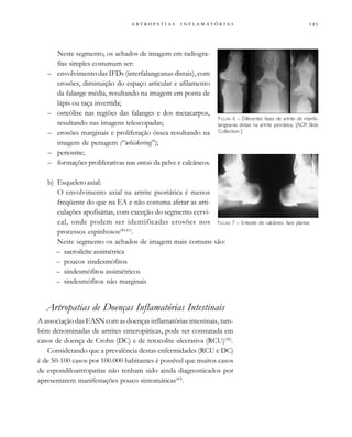                  
Neste segmento, os achados de imagem em radiogra-
fias simples costumam ser:
– envolvimento das IFDs (interfalangeanas distais), com
erosões, diminuição do espaço articular e afilamento
da falange média, resultando na imagem em ponta de
lápis ou taça invertida;
– osteólise nas regiões das falanges e dos metacarpos,
resultando nas imagens telescopadas;
– erosões marginais e proliferação óssea resultando na
imagem de penugem (“whiskering”);
– periostite;
– formações proliferativas nas entesis da pelve e calcâneos.
b) Esqueleto axial:
O envolvimento axial na artrite psoriática é menos
freqüente do que na EA e não costuma afetar as arti-
culações apofisárias, com exceção do segmento cervi-
cal, onde podem ser identificadas erosões nos
processos espinhosos(40,41)
.
Neste segmento os achados de imagem mais comuns são:
– sacroileíte assimétrica
– poucos sindesmófitos
– sindesmófitos assimétricos
– sindesmófitos não marginais
Artropatias de Doenças Inflamatórias Intestinais
A associação das EASN com as doenças inflamatórias intestinais, tam-
bém denominadas de artrites enteropáticas, pode ser constatada em
casos de doença de Crohn (DC) e de retocolite ulcerativa (RCU)(42)
.
Considerando que a prevalência destas enfermidades (RCU e DC)
é de 50-100 casos por 100.000 habitantes é possível que muitos casos
de espondiloartropatias não tenham sido ainda diagnosticados por
apresentarem manifestações pouco sintomáticas(43)
.
FIGURA 6 – Diferentes fases de artrite de interfa-
langeanas distais na artrite psoriática. [ACR Slide
Collection.]
FIGURA 7 – Entesite de calcâneo, face plantar.
 