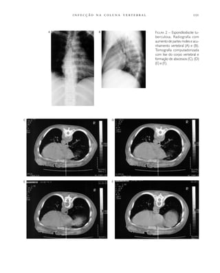                   
FIGURA 2 – Espondilodiscite tu-
berculosa. Radiografia com
aumento de partes moles e acu-
nhamento vertebral (A) e (B).
Tomografia computadorizada
com lise do corpo vertebral e
formação de abscessos (C), (D)
(E) e (F).
BA
C D
E F
 