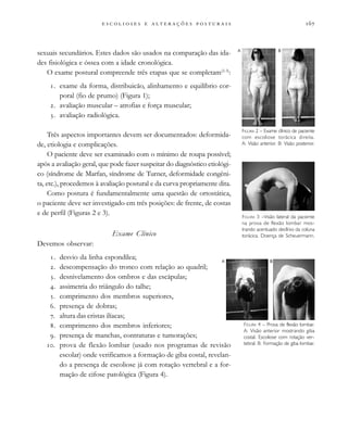                           
sexuais secundários. Estes dados são usados na comparação das ida-
des fisiológica e óssea com a idade cronológica.
O exame postural compreende três etapas que se completam(2-3)
:
. exame da forma, distribuicão, alinhamento e equilíbrio cor-
poral (fio de prumo) (Figura 1);
. avaliação muscular – atrofias e força muscular;
. avaliação radiológica.
Três aspectos importantes devem ser documentados: deformida-
de, etiologia e complicações.
O paciente deve ser examinado com o mínimo de roupa possível;
após a avaliação geral, que pode fazer suspeitar do diagnóstico etiológi-
co (síndrome de Marfan, síndrome de Turner, deformidade congêni-
ta, etc.), procedemos à avaliação postural e da curva propriamente dita.
Como postura é fundamentalmente uma questão de ortostática,
o paciente deve ser investigado em três posições: de frente, de costas
e de perfil (Figuras 2 e 3).
Exame Clínico
Devemos observar:
. desvio da linha espondílea;
. descompensação do tronco com relação ao quadril;
. desnivelamento dos ombros e das escápulas;
. assimetria do triângulo do talhe;
. comprimento dos membros superiores,
. presença de dobras;
. altura das cristas ilíacas;
. comprimento dos membros inferiores;
. presença de manchas, contraturas e tumorações;
. prova de flexão lombar (usado nos programas de revisão
escolar) onde verificamos a formação de giba costal, revelan-
do a presença de escoliose já com rotação vertebral e a for-
mação de cifose patológica (Figura 4).
FIGURA 2 – Exame clínico de paciente
com escoliose torácica direita.
A: Visão anterior. B: Visão posterior.
FIGURA 3 –Visão lateral da paciente
na prova de flexão lombar mos-
trando acentuado declínio da coluna
torácica. Doença de Scheuermann.
FIGURA 4 – Prova de flexão lombar.
A: Visão anterior mostrando giba
costal. Escoliose com rotação ver-
tebral. B: Formação de giba lombar.
BA
BA
 