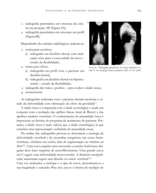                           
. radiografia panorâmica em ortostase da colu-
na em projeção AP (Figura 6A);
. radiografia panorâmica em ortostase em perfil
(Figura 6B).
Dependendo dos achados radiológicos, realizam-se:
. rotina para escoliose:
a) radiografia em decúbito dorsal, com incli-
nação ativa para a convexidade da curva –
estudo da flexibilidade;
. rotina para cifose:
a) radiografia em perfil com o paciente em
decúbito lateral;
b) radiografia em decúbito dorsal em hiperex-
tensão – estudo da flexibilidade;
. radiografia das mãos e punhos – para avaliar a idade óssea;
. escanometria.
As radiografias realizadas com o paciente deitado mostram o es-
tado da deformidade com eliminação de efeito da gravidade(7)
.
A idade óssea é comparada com a idade cronológica e usada em
conjunto com a avaliação das epífises ilíacas (sinal de Risser) e das
apófises anulares vertebrais. O conhecimento da maturidade óssea é
importante na decisão do programa de tratamento do paciente. Por-
tanto, a idade óssea é mais valiosa que a idade cronológica, já que
constitui uma representação verdadeira da maturidade óssea.
Na análise das radiografias procura-se determinar a etiologia da
deformidade vertebral e de anomalias congênitas tais como hemi-
vértebras, vértebras em cunha, falta de segmentação ou vértebra em
bloco(8,9)
. Uma curva angular curta associada a costelas fusiformes del-
gadas deve fazer suspeitar de neurofibromatose. Uma grande curva
em C sugere uma deformidade neurovascular. A distância interpedi-
cular aumentada sugere uma disrafia ou tumor vertebral(10)
.
Uma vez analisados a etiologia e o tipo de curva, determinam-se a
sua magnitude e extensão. Para isto, usa-se a técnica de medição de
FIGURA 6 – Radiografia panorâmica da coluna vertebral nor-
mal. A: em projeção ântero-posterior (AP). B: em perfil.
A B
 