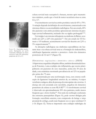         
coluna cervical mais susceptível a fraturas, mesmo após traumatis-
mos mínimos, sendo que o local de maior ocorrência situa-se entre
C6 e C7.
O acometimento cervical na artrite psoriática varia de 45% a 70%.
A variação depende da definição do envolvimento, caracterizado com
sintomas clínicos ou anormalidades radiológicas. Em um estudo, 40%
dos pacientes com artrite psoriática apresentavam sintomas de pato-
logia cervical inflamatória, incluindo dor ou rigidez prolongada(49,50)
.
Cervicalgia é um sintoma infreqüente na síndrome de Reiter, ocor-
rendo em 2,2% a 2,4% dos pacientes(51)
. Em um estudo de 153 ho-
mens e 119 mulheres, acometimento cervical foi descrito em 2,5% e
5% respectivamente(52)
.
As alterações radiológicas nas síndromes espondilíticas são bas-
tante ricas e na coluna cervical nota-se a formação de sindesmófitos,
calcificação ligamentar anterior e posterior e fusão dos elementos
posteriores de C2 até C7 (Figura 10).
HIPEROSTOSE ESQUELÉTICA IDIOPÁTICA DIFUSA (DISH)
A hiperostose esquelética idiopática difusa, também denominada doen-
ça de Forestier, é uma condição não inflamatória, que ocorre princi-
palmente em pacientes do sexo masculino, acima dos 50 anos de
idade, com estatísticas mostrando prevalência de até 12% na popula-
ção acima dos 75 anos.
É caracterizada por uma neoformação óssea, com extensa ossifi-
cação do ligamento longitudinal anterior de, no mínimo, 4 corpos
vertebrais contíguos, além da presença de entesopatias não-erosivas. A
doença não está associada com sacroileíte, anquilose de elementos
posteriores da coluna ou com HLA-B27(53)
. O envolvimento cervical
é observado em aproximadamente 50% dos pacientes, sendo menos
freqüente que o dorso-lombar(54)
. Em razão da ossificação exuberante
das estruturas paraespinhais (Figura 11), pode ocorrer disfagias pela
formação osteofitária anterior, com compressão da laringe e terço
proximal do esôfago, sendo mais freqüente nos co rpos vertebrais C5
e C6 (Figura 12). Torna-se importante uma avaliação radiológica da
FIGURA 10 – Espondilite anquilo-
sante. Radiografia em perfil
mostrando retificação da coluna
cervical e fusão dos elementos
posteriores de C2 a C7.
 