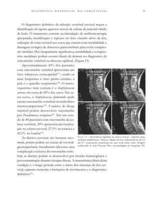                                 
O diagnóstico definitivo da infecção vertebral cervical requer a
identificação do agente agressor através de cultura de material obtido
da lesão. O tratamento consiste na introdução de antibioticoterapia
apropriada, imobilização e repouso no leito visando alívio da dor,
utilização de colar cervical nos casos que cursam com instabilidade e
drenagem cirúrgica de abscessos paravertebrais para evitar compres-
são medular. Dor incapacitante significativa, instabilidade e compres-
sões medulares podem ocorrer diante da demora no diagnóstico de
osteomielite vertebral ou abscesso epidural. (Figura 13)
Aproximadamente 40% dos pacientes
com osteomielite vertebral apresentam um
foco infeccioso extraespinhal(57)
, sendo os
mais freqüentes o trato gênito-urinário, a
pele e o aparelho respiratório(58)
. O micro-
organismo mais comum é o Staphylococcus
aureus, em cerca de 60% dos casos. Em ra-
ros casos, o Staphylococcus epidermidis pode
causar osteomielite vertebral em indivíduos
imunocompetentes(59)
. Usuários de droga
injetável podem desenvolver osteomielite
por Pseudomonas aeruginosa(60)
. Em um estu-
do de 40 pacientes com osteomielite da co-
luna vertebral, 30% apresentavam localiza-
ção na coluna cervical, 27,5% na torácica e
42,5% na lombar(61)
.
As discites cervicais são bastante inco-
muns, porém podem ser causas de cervical-
gia incapacitante. Inicialmente tida como uma
complicação exclusiva da osteomielite verte-
bral, as discites podem se desenvolver por invasão hematogênica e
por contaminação durante cirurgias discais. A característica clínica desta
condição é o longo período entre o início dos sintomas de dor cer-
vical, espasmo muscular e limitações de movimentos e o diagnóstico
definitivo(62)
.
FIGURA 13 – Ressonância magnética da coluna cervical – abscesso para-
vertebral estafilocócico. Nota-se coleção laminar estendendo-se de C3
até C7, ocasionando compressão do saco dural nestes niveis. (Imagem
cedida pelo dr. José Marques Filho, reumatologista de Araçatuba, SP.)
 