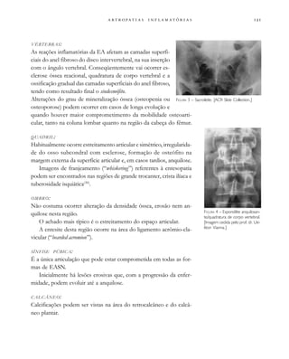 
                 
VÉRTEBRAS:
As reações inflamatórias da EA afetam as camadas superfi-
ciais do anel fibroso do disco intervertebral, na sua inserção
com o ângulo vertebral. Conseqüentemente vai ocorrer es-
clerose óssea reacional, quadratura de corpo vertebral e a
ossificação gradual das camadas superficiais do anel fibroso,
tendo como resultado final o sindesmófito.
Alterações do grau de mineralização óssea (osteopenia ou
osteoporose) podem ocorrer em casos de longa evolução e
quando houver maior comprometimento da mobilidade osteoarti-
cular, tanto na coluna lombar quanto na região da cabeça do fêmur.
QUADRIL:
Habitualmente ocorre estreitamento articular e simétrico, irregularida-
de do osso subcondral com esclerose, formação de osteófito na
margem externa da superfície articular e, em casos tardios, anquilose.
Imagens de franjeamento (“whiskering”) referentes à entesopatia
podem ser encontrados nas regiões de grande trocanter, crista ilíaca e
tuberosidade isquiática(30)
.
OMBRO:
Não costuma ocorrer alteração da densidade óssea, erosão nem an-
quilose nesta região.
O achado mais típico é o estreitamento do espaço articular.
A entesite desta região ocorre na área do ligamento acrômio-cla-
vicular (“bearded acromion”).
SÍNFISE PÚBICA:
É a única articulação que pode estar comprometida em todas as for-
mas de EASN.
Inicialmente há lesões erosivas que, com a progressão da enfer-
midade, podem evoluir até a anquilose.
CALCÂNEO:
Calcificações podem ser vistas na área do retrocalcâneo e do calcâ-
neo plantar.
FIGURA 3 – Sacroileíte. [ACR Slide Collection.]
FIGURA 4 – Espondilite anquilosan-
te/quadratura de corpo vertebral.
[Imagem cedida pelo prof. dr. Ue-
liton Vianna.]
 