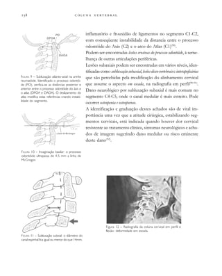         

inflamatório e frouxidão de ligamentos no segmento C1-C2,
com conseqüente instabilidade da distancia entre o processo
odontóide do Axis (C2) e o arco do Atlas (C1)(90)
.
Podem ser encontradas lesões erosivas do processo odontóide, à seme-
lhança de outras articulações periféricas.
Lesões subaxiais podem ser encontradas em vários níveis, iden-
tificadascomosubluxaçãosubaxial,lesõesdisco-vertebraiseinterapofisárias
que são percebidas pela modificação do alinhamento cervical
que assume o aspecto em escada, na radiografia em perfil(90-91)
.
Dano neurológico por subluxação subaxial é mais comum no
segmento C4-C5, onde o canal medular é mais estreito. Pode
ocorrer osteopenia e osteoporose.
A identificação e graduação destes achados são de vital im-
portância uma vez que a atitude cirúrgica, estabilizando seg-
mentos cervicais, está indicada quando houver dor cervical
resistente ao tratamento clínico, sintomas neurológicos e acha-
dos de imagem sugerindo dano medular ou risco eminente
deste dano(92)
.
FIGURA 9 – Subluxação atlanto-axial na artrite
reumatóide. Identificado o processo odontói-
de (PO), verifica-se as distâncias posterior e
anterior entre o processo odontóide do áxis e
o atlas (DPOA e DAOA). O deslizamento do
atlas modifica estas referências criando instabi-
lidade do segmento.
FIGURA 11 – Subluxação subxial: o diâmetro do
canal espinhal fica igual ou menor do que 14mm.
FIGURA 10 – Invaginação basilar: o processo
odontóide ultrapassa de 4,5 mm a linha de
McGregor.
Figura 12 – Radiografia da coluna cervical em perfil e
flexão: deformidade em escada.
 