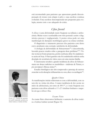         

está recomendado para pacientes que apresentam grande descom-
pensação do tronco com relação à pelve e cuja escoliose continua
evoluindo. Uma escoliose descompensada tem propensão para evo-
lução, mesmo com o uso adequado do colete.
Cifose Juvenil
A cifose é outra deformidade muito freqüente na infância e adoles-
cência. Muitas vezes é confundida com vício postural e assim o diag-
nóstico precoce é negligenciado. A postura viciosa pode ser uma
manifestação de alterações morfológicas graves na coluna vertebral.
O diagnóstico e tratamento precoces dos pacientes com dorso
curvo produzem uma correção satisfatória da deformidade.
A etiologia da deformidade de Scheuermann(29)
é desconhecida,
havendo poucos estudos sobre a patogenia deste problema(30,31)
. Vá-
rias teorias já foram propostas, porém nenhuma delas foi amplamen-
te aceita até hoje. O fator genético não foi estabelecido embora tenha
descrição da ocorrência de vários casos em uma mesma família.
É interessante ressaltar a grande incidência da cifose de Scheuer-
mann nas doenças endócrinas ou metabólicas – síndrome de Turner, es-
pru não-tropical e fibrose cística(32)
.
Estudos histológicos não têm comprovado a presença de necrose
avascular ou de alterações inflamatórias no osso, disco ou cartilagem(33)
.
Quadro Clínico
As manifestações iniciais relacionam-se com a deformidade, com ou
sem dor no vértice da cifose. A maior incidência de dor ocorre no
início da adolescência, em torno de 50%(34)
, e é mais freqüente nos
pacientes com cifose afetando a 1.ª e 2.ª vértebras lombares e naque-
les em que a cifose é fixa.
Exame Físico
Ao exame físico observamos facilmente o aumento da cifose toráci-
ca e lordose lombar normal (Figura 15).
FIGURA 15 – Exame do paciente
em perfil mostrando aumento da
cifose torácica e lordose lombar.
 