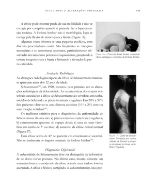 
                          
A cifose pode mostrar perda de sua mobilidade e não se
corrigir por completo quando o paciente faz a hiperexten-
são torácica. A lordose lombar não é morfológica, logo se
corrige pela flexão do tronco para a frente (Figura 16).
Algumas vezes observa-se uma pequena escoliose, com
discreta proeminência costal. São freqüentes as retrações
musculares e as contraturas aparentes, particularmente ob-
servadas nos músculos peitorais e isquiossurais, projetando a
cintura escapular para a frente e limitando a elevação da per-
na estendida.
Avaliação Radiológica
As alterações radiológicas típicas da cifose de Scheuermann raramen-
te aparecem antes dos 12 anos de idade.
Scheuermann(29)
, em 1920, mostrou pela primeira vez as altera-
ções radiológicas da deformidade. As características dos corpos ver-
tebrais secundários à cifose de Scheuermann são: vértebras em cunha,
nódulos de Schmorl e as placas terminais irregulares. Em 20% a 30%
dos pacientes observa-se uma discreta escoliose (10 o
a 20o
) com ou
sem rotação vertebral(35)
.
Os melhores critérios para o diagnóstico da enfermidade de
Scheuermann clássica são: a) placas terminais vertebrais irregulares;
b) estreitamento aparente do espaço discal; c) uma ou mais vérte-
bras em cunha de 5o
ou mais; d) aumento da cifose dorsal normal
(Figura 17).
Uma cifose acima de 40o
no paciente em crescimento é anormal.
Não se conhecem os ângulos normais da lordose lombar(35)
.
Diagnóstico Diferencial
A enfermidade de Scheuermann deve ser distinguida da deformida-
de de dorso curvo postural. No último caso, mostra somente um
aumento discreto a moderado da cifose dorsal e uma lordose lombar
acentuada. A cifose é flexível, corrigindo-se voluntariamente, não apre-
FIGURA 16 – Prova de flexão lombar mostrando
cifose patológica e correção da lordose lombar.
FIGURA 17 – Cifose de Scheuer-
mann. Vértebras em cunha,
nódulos de Schmorl e presen-
ça de placas terminais verte-
brais irregulares.
 