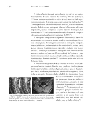         

A radiografia simples pode ser totalmente normal em um pacien-
te com hérnia de disco cervical. Ao contrário, 70% das mulheres e
95% dos homens assintomáticos entre 60 e 65 anos de idade apre-
sentam evidências de doença degenerativa discal nas radiografias(20)
.
A mielografia tem sido cada vez menos indicada, com exceções nos
estudos dinâmicos, nos quais pode oferecer informações adicionais
importantes, quando comparada a outros métodos de imagem. Em
um estudo de 53 pacientes com confirmação cirúrgica de compres-
são neural, a mielografia mostrou acurácia de 85%(21)
.
A tomografia computadorizada permite a visualização direta das
compressões em estruturas neurais, sendo portanto mais precisa do
que a mielografia. As vantagens adicionais da tomografia computa-
dorizada incluem a melhor definição das anormalidades laterais, como
p.ex. a estenose foraminal, menor exposição à radiação e ser menos
invasiva. A utilização conjunta da tomografia com contraste resulta
em um excelente método na diferenciação de lesões ósseas e dos
tecidos moles e permite a demonstração direta da medula espinhal e
das dimensões do canal vertebral(22)
. Possui uma acurácia de 96% nas
lesões cervicais.
A ressonância magnética (RM) é o exame de eleição na aborda-
gem das hérnias cervicais. Permite uma excelente visualização dos
tecidos paravertebrais, estruturas ligamentares e do grau de degenera-
ção discal, sendo um procedimento não-invasivo (Figura 6). Nem
todas as alterações discais reveladas pela RM são sintomáticas. Cerca
de 20% dos indivíduos assintomáti-
cos apresentam alterações, incluindo
protrusões discais, alterações de sinal
e processos degenerativos vertebrais
e facetários(23)
. Portanto, antes da so-
licitação de qualquer exame de ima-
gem, torna-se fundamental uma
anamnese e um exame físico bem
conduzidos, para uma melhor cor-
relação com os dados obtidos(24)
.
FIGURA 6 – Ressonância magnética de coluna cervical, mostrando hérnias discais
em C5-C6 e C6-C7, observando-se hipossinal dos respectivos discos, apaga-
mento da gordura epidural anterior, compressão sobre a face ventral do saco
dural. Redução do calibre foraminal em C6-C7 à esquerda.
 