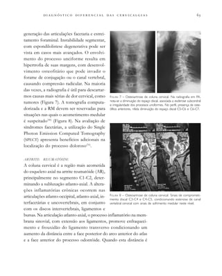 
                                
generação das articulações facetaria e estrei-
tamento foraminal. Instabilidade segmentar,
com espondilolistese degenerativa pode ser
vista em casos mais avançados. O envolvi-
mento do processo unciforme resulta em
hipertrofia de suas margens, com desenvol-
vimento osteofitário que pode invadir o
forame de conjugação ou o canal vertebral,
causando compressão radicular. Na maioria
das vezes, a radiografia é útil para descartar-
mos causas mais sérias de dor cervical, como
tumores (Figura 7). A tomografia computa-
dorizada e a RM devem ser reservadas para
situações nas quais o acometimento medular
é suspeitado(30)
(Figura 8). Na avaliação de
síndromes facetárias, a utilização do Single
Photon Emission Computed Tomography
(SPECT) apresenta benefícios adicionais na
localização do processo doloroso(31)
.
ARTRITE REUMATÓIDE
A coluna cervical é a região mais acometida
do esqueleto axial na artrite reumatóide (AR),
principalmente no segmento C1-C2, deter-
minando a subluxação atlanto-axial. A altera-
ções inflamatórias crônicas ocorrem nas
articulações atlanto-occipital, atlanto-axial, in-
terfacetárias e uncovertebrais, em conjunto
com os discos intervertebrais, ligamentos e
bursas. Na articulação atlanto-axial, o processo inflamatório na mem-
brana sinovial, com extensão aos ligamentos, promove enfraqueci-
mento e frouxidão do ligamento transverso condicionando um
aumento da distância entre a face posterior do arco anterior do atlas
e a face anterior do processo odontóide. Quando esta distância é
FIGURA 7 – Osteoartrose de coluna cervical. Na radiografia em PA,
nota-se a diminuição do espaço discal, associada a esclerose subcondral
e irregularidade dos processos unciformes. No perfil, presença de oste-
ófitos anteriores, nítida diminuição do espaço discal C5-C6 e C6-C7.
FIGURA 8 – Osteoartrose de coluna cervical. Sinais de comprometi-
mento discal C3-C4 e C4-C5, condicionando estenose de canal
vertebral cervical com sinais de sofrimento medular neste nível.
 