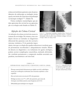 
                                
coluna cervical destes pacientes antes de proce-
dimentos de endoscopia ou intubação orotra-
queal, com intuito de evitar riscos de perfuração
ou laceração esofágica(55,56)
. (Tabela 14)
Outras condições reumatológicas que po-
dem apresentar dor cervical na sua apresenta-
ção ou evolução estão listadas na Tabela 15.
Infecções da Coluna Cervical
As infecções da coluna cervical são causas in-
comuns de cervicalgia. No entanto, estas con-
dições devem ser incluídas no diagnóstico
diferencial dos pacientes com dor cervical e
sintomas sistêmicos. É de particular impor-
tância, visto que a evolução dos quadros infecciosos é excelente quan-
do prontamente reconhecidos e adequadamente tratados. Diante
da demora no diagnóstico e no isolamento do agente etiológico,
podem ocorrer complicações catastróficas, incluindo deformida-
des vertebrais permanentes e compressão medular associada com
paralisias, incontinência e até êxito letal.
FIGURA 11 – Hiperostose esquelética idiopática difusa. Presença de
extensa ossificação do ligamento longitudinal anterior e posterior,
interessando mais de quatro corpos vertebrais contíguos, com pre-
servação relativa do espaço discal.
FIGURA 12 – Calficação/ossificação
do ligamento longitudinal anteri-
or em C4 até C7, associada a
alterações osteoartrósicas difusas.
TABELA 14
HIPEROSTOSE ESQUELÉTICA IDIOPÁTICA DIFUSA (DISH)
Doença caracterizada clinicamente por rigidez cervical e radiológica-
mente por ossificações exuberantes das estruturas espinhais e extra-
espinhais
Dor cervical ocorre em cerca de 50% dos pacientes
Disfagia acontece em 17% a 28% dos pacientes, por causa da
formação osteofitária anterior, mais freqüente em C5-C6
Dificuldade para intubação oro-traqueal
 