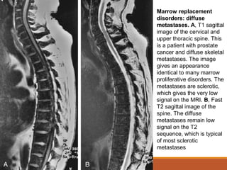 Marrow replacement
disorders: diffuse
metastases. A, T1 sagittal
image of the cervical and
upper thoracic spine. This
is a patient with prostate
cancer and diffuse skeletal
metastases. The image
gives an appearance
identical to many marrow
proliferative disorders. The
metastases are sclerotic,
which gives the very low
signal on the MRI. B, Fast
T2 sagittal image of the
spine. The diffuse
metastases remain low
signal on the T2
sequence, which is typical
of most sclerotic
metastases
 