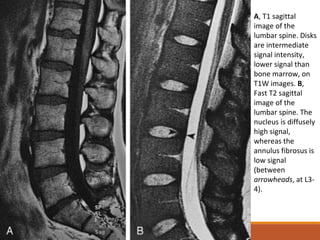A, T1 sagittal
image of the
lumbar spine. Disks
are intermediate
signal intensity,
lower signal than
bone marrow, on
T1W images. B,
Fast T2 sagittal
image of the
lumbar spine. The
nucleus is diffusely
high signal,
whereas the
annulus fibrosus is
low signal
(between
arrowheads, at L3-
4).
 