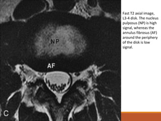 Fast T2 axial image,
L3-4 disk. The nucleus
pulposus (NP) is high
signal, whereas the
annulus fibrosus (AF)
around the periphery
of the disk is low
signal.
 