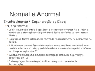 Normal e Anormal
Envelhecimento / Degeneração do Disco:
◦Núcleo Anormal:
◦Com o envelhecimento e degeneração, os discos intervertebrais perdem a
hidratação e proteoglicanos e ganham colágeno conforme se tornam mais
fibrosos.
◦Uma fissura fibrosa intranuclear orientada horizontalmente se desenvolve no
núcleo.
◦A RM demonstra uma fissura intranuclear como uma linha horizontal, com
sinal de baixa intensidade, que divide o disco em metades superior e inferior
nas imagens sagitais em T2.
◦Eventualmente, há sinal difuso de intensidade diminuída nas imagens
ponderada em T2.
◦O disco progressivamente perde altura com graus crescentes de
degeneração.
 