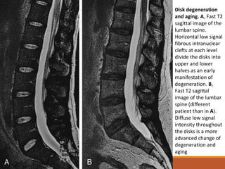 Disk degeneration
and aging. A, Fast T2
sagittal image of the
lumbar spine.
Horizontal low signal
fibrous intranuclear
clefts at each level
divide the disks into
upper and lower
halves as an early
manifestation of
degeneration. B,
Fast T2 sagittal
image of the lumbar
spine (different
patient than in A).
Diffuse low signal
intensity throughout
the disks is a more
advanced change of
degeneration and
aging
 