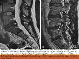Annular tears. A, Fast T2 sagittal image of the lumbar spine. There is a focal line of increased signal in the
posterior midline of the L5-S1 annulus (arrow), representing a radial tear/fissure or high intensity zone. The
disk is protruding posteriorly slightly. B, Fast T2 sagittal image of the lumbar spine (different patient than in
A). A focal high intensity zone (arrow) from a radial tear of the L4-5 annulus is seen in the region of the left
neural foramen.
 
