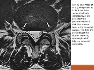 Fast T2 axial image of
L4-5 (same patient as
in B). Short, linear
segments of high
signal (arrows) are
present in the
posterolateral L4-5
disk from annular
tears in the foraminal
regions. The disks are
protruding at the
sites of the tears,
resulting in mild
bilateral foraminal
narrowing.
 