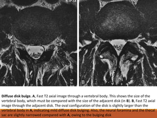 Diffuse disk bulge. A, Fast T2 axial image through a vertebral body. This shows the size of the
vertebral body, which must be compared with the size of the adjacent disk (in B). B, Fast T2 axial
image through the adjacent disk. The oval configuration of the disk is slightly larger than the
vertebral body in A, indicating mild diffuse disk bulging. Also, the neural foramina and the thecal
sac are slightly narrowed compared with A, owing to the bulging disk
 