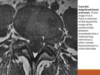 Focal disk
bulge/broad-based
protrusion. Tl axial
image of L4-5.
There is extension
of disk beyond the
margin of the
vertebral body
(between
arrowheads) that is
relatively long,
referred to as
either a broad-
based protrusion or
a focal disk bulge
 