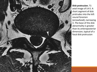 Disk protrusion. T1
axial image of L4-5. A
short segment of disk
protrudes into the left
neural foramen
(arrowhead), narrowing
it. The base of the disk
abnormality is greater
than its anteroposterior
dimension, typical of a
focal disk protrusion
 