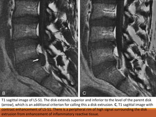 T1 sagittal image of L5-S1. The disk extends superior and inferior to the level of the parent disk
(arrow), which is an additional criterion for calling this a disk extrusion. C, T1 sagittal image with
contrast enhancement of L5-S1. There is a peripheral rim of high signal surrounding the disk
extrusion from enhancement of inflammatory reactive tissue.
 