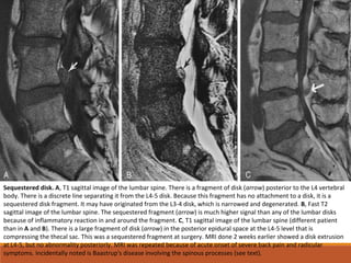 Sequestered disk. A, T1 sagittal image of the lumbar spine. There is a fragment of disk (arrow) posterior to the L4 vertebral
body. There is a discrete line separating it from the L4-5 disk. Because this fragment has no attachment to a disk, it is a
sequestered disk fragment. It may have originated from the L3-4 disk, which is narrowed and degenerated. B, Fast T2
sagittal image of the lumbar spine. The sequestered fragment (arrow) is much higher signal than any of the lumbar disks
because of inflammatory reaction in and around the fragment. C, T1 sagittal image of the lumbar spine (different patient
than in A and B). There is a large fragment of disk (arrow) in the posterior epidural space at the L4-5 level that is
compressing the thecal sac. This was a sequestered fragment at surgery. MRI done 2 weeks earlier showed a disk extrusion
at L4-5, but no abnormality posteriorly. MRI was repeated because of acute onset of severe back pain and radicular
symptoms. Incidentally noted is Baastrup's disease involving the spinous processes (see text).
 