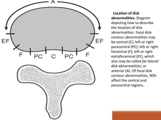 Location of disk
abnormalities. Diagram
depicting how to describe
the location of disk
abnormalities. Focal disk
contour abnormalities may
be central (C); left or right
paracentral (PC); left or right
foraminal (F); left or right
extraforaminal (EF), which
also may be called far lateral
disk abnormalities; or
anterior (A). Of focal disk
contour abnormalities, 90%
affect the central and
paracentral regions.
 